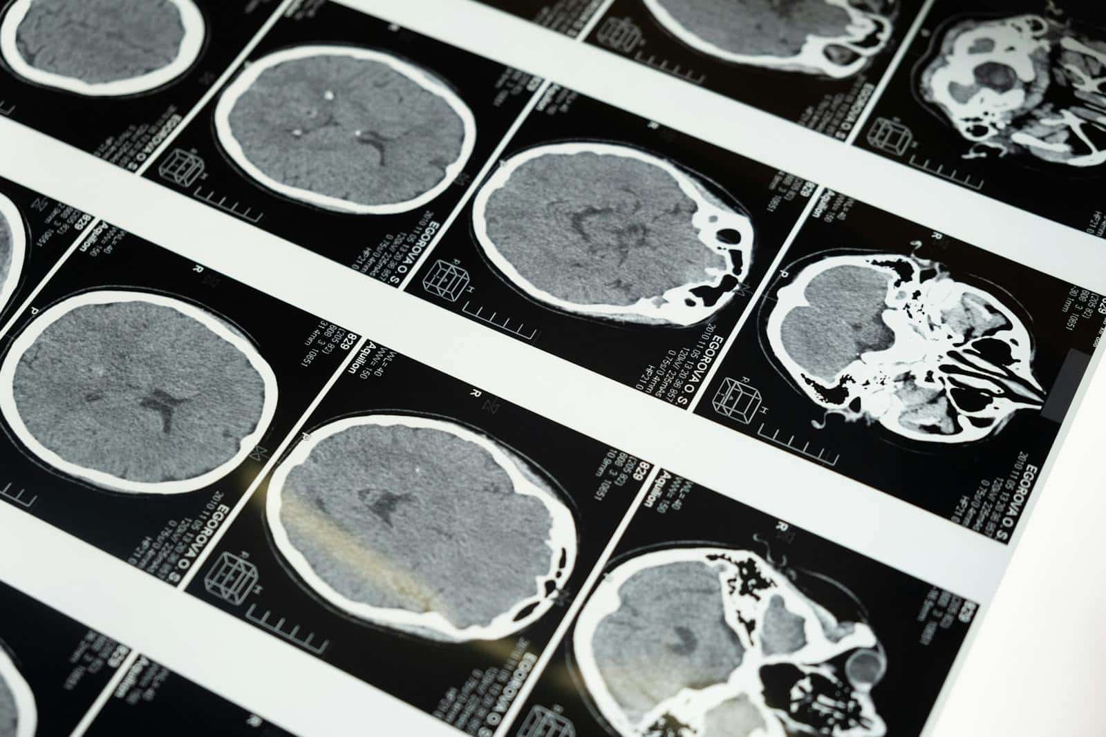 does weed kill brain cells, effects of cannabis on the brain, effects of weed on the brain, how weed affects the brain, marijuana effects on the brain, THC brain effects, cognitive effects of cannabis, impact of weed on the brain, weed and memory loss, does smoking weed damage your brain, cannabis and adolescence