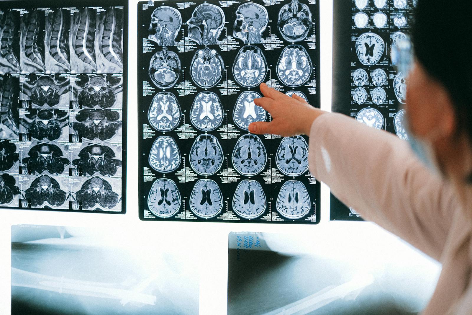Does weed kill brain cells, memory loss and marijuana, marijuana and adolescence, Does smoking marijuana kill brain cells,